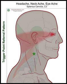 Neck-ache Headache, Eye-ache - Integrative Works Eye Activities, Cervicogenic Headache, Trigger Points Neck, Neck Ache, Trigger Point, Trigger Points, Neck Pain, The Eye, Headache