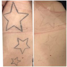 before and after photos of a woman's tattoo