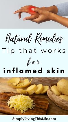 Cheap natural home remedies for inflamed, sore & cracked skin. Tips how to use a potato poultice to help your skin heal literally overnight! (In our experience.) Also how to make an all-natural, gentle Foaming hand soap that will keep your skin from breaking out again from toxic & chemical conventional soap. Super simple DIY foaming hand soap recipe that will save you money too. Cheap, easy, simple, all-natural Castile Foaming hand soap recipe. Potato Poultice, Diy Foaming Hand Soap Recipes, Homestead Crafts, Foaming Hand Soap Recipe, Hand Soap Recipe, Diy Foaming Hand Soap, Natural Mama, Inflamed Skin, Soap For Sensitive Skin