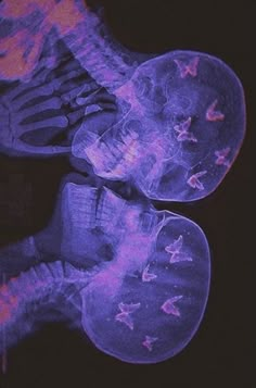 an x - ray image of someone's feet with butterflies on them in purple