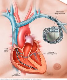 the heart is connected to an electrical device in order to control it's flow