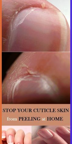 An in-depth guide to keeping your cuticles healthy and moisturizedDry, peeling cuticles can be quite painful and look unsightly. Luckily, this is one problem you can solve without too much time or effort—you just need to be prepared to... Peeling Cuticles, Natural Nail Care, Baking Soda Shampoo, Beauty Diy, Oil Skin Care