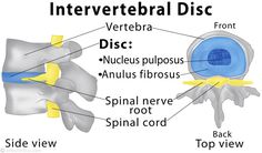 Low Back Strain and Sprain Pinched Nerve In Lower Back, Cervical Disc, Intervertebral Disc, Spinal Fusion, Spinal Nerve, Improve Nutrition, Physiotherapy Clinic, Pinched Nerve, Inflammation Causes