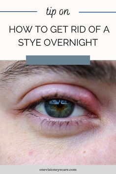 We have about 30 oil glands in our upper and lower eye lid. When one of these glands gets clogged the problem can start. The Clogged oil gland can get infected with bacteria and pus builds up and voila you have a stye or external hordeolum. Type Treatments, Vision Eye, Healthy Liver, Back Pain Exercises, Natural Health Remedies, Clean Face