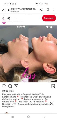 Facial Plastic Surgery Before After, Double Chin Lipo Before And After, Before And After Jaw Filler, Jaw Contouring Filler, Face Surgery Before And After, Cheek And Chin Filler, Chin Jaw Filler, Chin Enhancement Before After