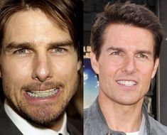 Celebrities With Veneers, Tom Cruise Teeth, Veneers Teeth Cost, Tom Cruise Jawline, Celebrity Teeth, Cosmetic Dentistry Veneers, Celebrity Smiles, Teeth Bleaching, Perfect Teeth