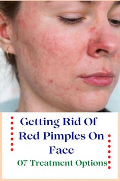 Are you looking for red pimples on face treatment? Many teenagers experience red pimple breakouts on their face during puberty due to many reasons. Face Pimples, Redness Pimple, How To Reduce Pimples, Bad Acne, Pimples Remedies, Pimples On Face