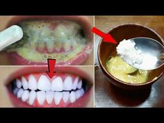 Turmeric Teeth Whitening, Baking Soda Teeth, Natural Teeth Whitening Remedies, Baking Soda Teeth Whitening, Teeth Whitening Methods, Teeth Whitening Homemade, Baking Soda Benefits, Teeth Whitening Remedies, Teeth Whitening Diy