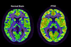 Alcohol Use Disorder, Emdr Therapy, Memory Problems, Harvard Medical School, Post Traumatic, Mental Disorders