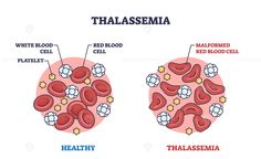 Thalassemia blood disorder caused by lack of hemoglobin outline diagram. Labeled educational scheme with healthy red blood cells vs malformed vector illustration. Microbiological disorder explanation #Thalassemia #blood #anemia #disease #health #commercial #vector #illustration → Get this Illustration for Commercial Use! Biology Projects, Iron Rich, Microbiology, Mind Map, Editing Software, Neuroscience