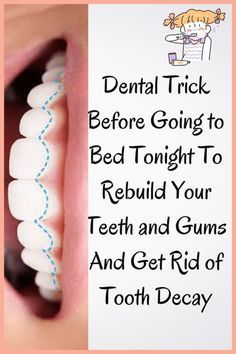 Natural Cavity Remedy, Holistic Dentistry, Tooth Decay Remedies, Natural Mouthwash, Strong Teeth, Healthy Teeth And Gums, Tooth Care, Dental Health Care, Teeth Whitening Diy