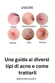 #acne #acne #acnetreatment #trattamentoperl'acne #acnefacemask #mascheraperilvisocontrol'acne #acneroutineskincare #curadellapellediroutineperl'acne #acneskincareroutinenight #Routinenotturnaperl"acuradellapelle #control'acne #acnereams #cremeperl'acne Acne Skincare