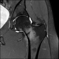 Stress fractures refer to fractures occurring in bone due to a mismatch of bone strength and chronic mechanical stress placed upon the bone. Fractures can either be: fatigue fracture: abnormal stresses on normal bone insufficiency fracture: normal stresses on abnormal bone http://radiopaedia.org/articles/stress-fractures Bone Strength, Radiology, The Bone, Medical Students, Medical, Health