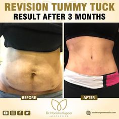 There are some cases in which patients are not satisfied with their outcomes. We often treat patients who have gotten a tummy tuck elsewhere, who come to Dr Monisha Kapoor Aesthetics to find out whether they need a revision procedure. #tummytuck #tummytuckrevision #abdominoplasty #revisionabdominoplasty #fatredcutionsurgery #bodycontouring #contourcorrection #tummytucksurgery #tummytucksurgeon #plasticsurgeon #drmonishakapoor #plasticsurgeryclinic Acid Reflux Diet, Mommy Makeover, Tummy Tucks, Acid Reflux, Plastic Surgeon, Body Contouring, Delhi India, Plastic Surgery