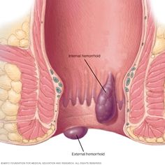 Hemorrhoid Remedies, Hemorrhoid Relief, Natural Treatments, Home Remedies, Natural Remedies, Anatomy