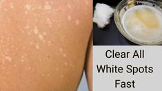 How To Get Rid Of White Spots On Skin, White Patches On Skin, White Spots On Skin, White Spots On Nails, Homemade Lotion, Home Health Remedies