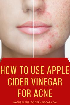 a woman's face with the words how to use apple cider vinegar for acne