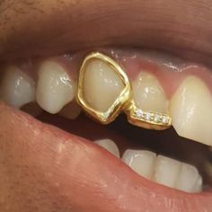 a close up of a person's mouth with gold teeth and braces on