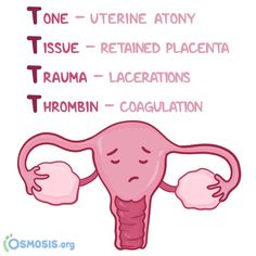 Postpartum Hemorrhage Nursing, Post Partum Hemorrhage, Pediatric Nursing Study, Disseminated Intravascular Coagulation, Postpartum Hemorrhage, Nursing Things, Nurse Notes, Assistant Nurse, Newborn Nursing