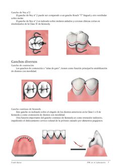 P P R E N L A B( K A I S E R) Dental Prosthesis, Medical Drawings, Partial Dentures, Dental Student, Clinic Design