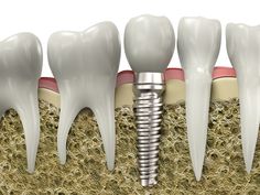 Dental Implants Kennewick WA Dental Implant Procedure, Implant Dentist, Tooth Replacement, Teeth Implants, Dental Bridge, Dental Crowns