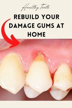 Teeth Cleaning At Home, Aesthetic Teeth, Hygiene Hacks, Reverse Cavities, Teeth Cleaning Tools, Dentist Teeth, Gum Recession