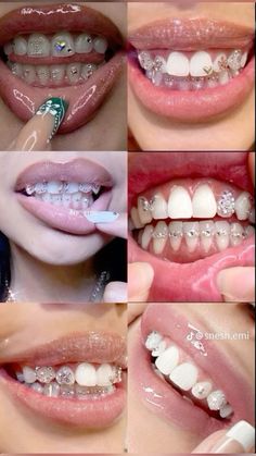 the steps to whiten teeth are shown in four different pictures, including one with braces