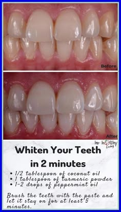 Turmeric Teeth Whitening, Baking Soda Teeth, Teeth Whitening Homemade, Teeth Health, Natural Teeth Whitening, Gum Health