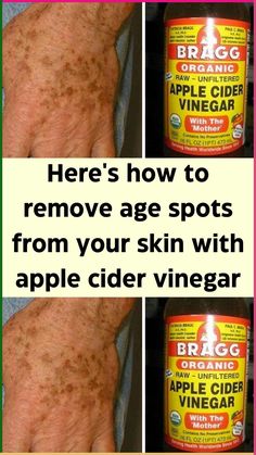 Age spots, the bane of sun worshipers existence in their older age. Indeed, age spots are often associated more with “age” then the cause of them, which is increased exposure to the rays of the sun over many years. Therefore, a younger person could also experience them if they were an over-frequent user of the tanning beds, for example.
Typically it is those with fairer skin who experience age spots more often in life as their skin is more vulnerable to the sun’s rays Diy Age Spot Remover The Face, Remove Brown Spots On Skin, Natural Age Spot Remover, Removing Sun Spots On Face, Leg Skin Care Dark Spots, Get Rid Of Age Spots On Face, Diy Age Spot Remover, How To Get Rid Of Age Spots, Remove Age Spots On Face