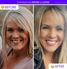 Wow, what a difference your smile can make to your happiness, wellness, and self-confidence! Here is the ultimate collection of Smile Direct before and after photos: #smileclubdirect #smiledirectclub #transformationtuesday #invisiblebraces #clearaligners Smile Direct Club, Invisalign Before And After, Smile Direct Club Before And After, Braces Before And After Overbite, Fix Overbite, Overbite Before And After, Straight Teeth Invisalign, Noom Coach, Byte Aligners Before And After