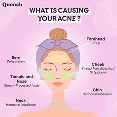 Acne ruins your day, doesn’t it? As numerous factors play a part in causing acne on the skin, excess oil production, hormonal changes, pollution and inflammation are the most common ones. Products recommended 🌸 Mama Cita Zit Away Treatment Patches 🌸Mama Cica Pore Clearing Face Wash 🌸Chialeader Zit Fix Serum 🌸Mama Cica Dark Spot Clearing Ampule 🌸Chialeader Oil Control Mousturizer Visit the link in pin to checkout our #MadeInKorea skincare babies now 🌸 Pore Skincare, Best Korean Skincare Products, Best Korean Skincare, Natural Face Cleanser, Skin Advice, Korean Skincare Products, Acne Skincare Routine