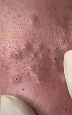 Huge Blackheads, Blackheads On Face, Zits Popping, Clean Blackheads, Remove Blackheads, Clear Skin Tips, Acne Solutions, Satisfying Videos