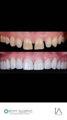 Perfect Smile Teeth, Dental Fillings, Dental Art, Smile Teeth, Smile Design, Perfect Smile, Surgery