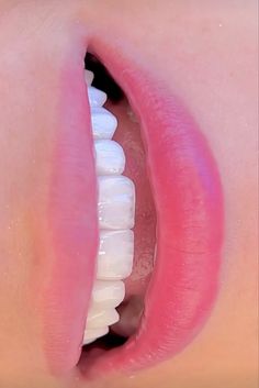 Teeth Aesthetic, Blush Pink Nails, Cute Braces