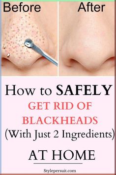 You can easily get rid of these blackheads by using natural or home remedies for blackhead treatment. Click to read How to get rid of blackheads diy| The best blackheads removal on nose| get rid of blackhads on face| get rid of blackheads on nose| how to get rid of blackheads naturally ... Natural Blackhead Remover, Remedies For Blackheads, Reverse Wrinkles, Soothing Face Mask, Remove Blackheads From Nose, How To Remove Blackheads, Overnight Skin Care, Blackhead Remover Diy