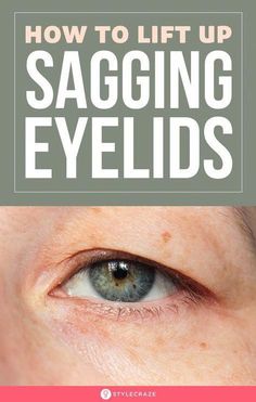 As the saying commonly goes, the eyes are the windows to one’s soul. So understandably, you would want to keep your precious peepers in tip-top shape Saggy Eyes, Saggy Eyelids, Sagging Eyelids, Natural Skin Tightening, Droopy Eyelids, Eyelid Lift, Skin Care Wrinkles, Random Aesthetic, Face Wrinkles