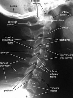 an x - ray shows the location of the lumbal sacula in the chest