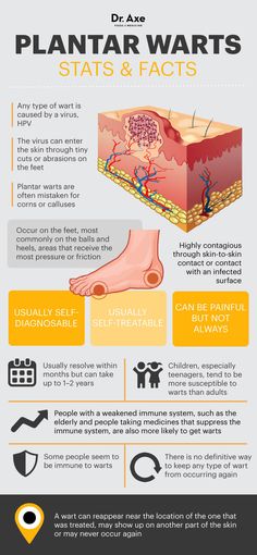 Plantar warts facts - Dr. Axe http://www.draxe.com #health #holistic #natural Planters Wart, How To Remove Warts, Remove Warts, Natural Cough Remedies