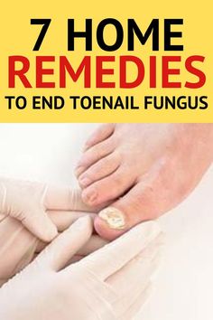 Discover seven effective home remedies to eradicate toenail fungus. Explore natural solutions that can help you regain healthy nails and confidence. Say goodbye to toenail fungus with these simple yet powerful remedies you can try at home. Best Nail Fungal Treatment Home Remedies For Sunburn, Aloe Vera For Sunburn, Home Remedies For Allergies, Home Remedies For Warts, Warts Remedy, Natural Remedies For Migraines