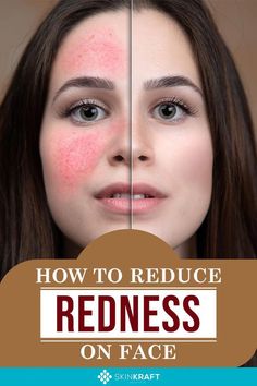 SkinKraft elaborates on the various reasons behind redness on facial skin and the possible remedies. Learn about all the precautions to be taken as well. Facial Redness Remedies, Red Cheeks Remedy, How To Reduce Redness On Face, Face Redness Remedy, Skin Redness Remedies, Red Rash On Face, Skin Irritation Remedies, Redness Remedy