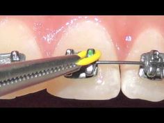 Diy Braces, Teeth Whitening Procedure, Dental World, Braces Tips, Getting Braces, Dental Videos, Dental Photography, Tooth Whitening, Dental Fun