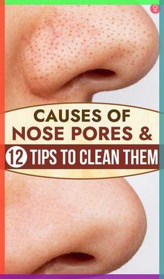 Are the pores on your nose getting bigger? Such big pores are a result of accumulated dirt that can harm the skin. Is there a way to unclog and shrink them Clean Nose Pores, Castor Oil For Skin, Big Pores, Nose Pores, Natural Face Skin Care, Best Moisturizer, Clean Pores, Unclog Pores