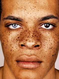 an image of a man with freckles on his face and the caption reads,