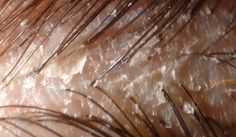 dandruff scalp behind ear Oily Dandruff Scalp, Dry Scaly Scalp, Scalp Scaler, Cat Dandruff, Sebboric Dermitis Scalp, Gross Anatomy, Growth Tips, Hair Growth Tips, Close Up Pictures