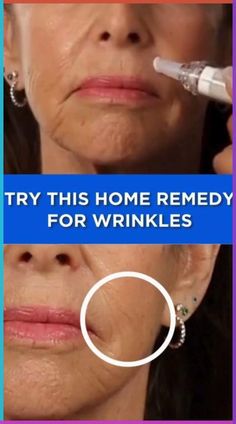 This at home remedy for aging wrinkles doesn’t require cream. Watch Now >> Rid Wrinkles, Natural Wrinkle Remedies, Face Wrinkles Remedies, Wrinkles Remedies Face, Home Remedies For Wrinkles, Glowing Skin Secrets, Wrinkle Remedies, Lip Wrinkles