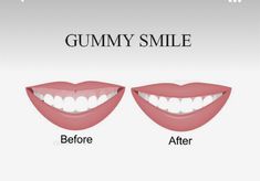 the stages of gumy smile before and after