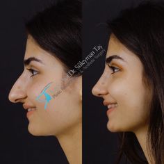 Long Nose Rhinoplasty, Natural Rhinoplasty Nose Jobs, Long Nose, Models With Big Noses, Rhinoplasty Side Profile, Rhinoplasty Bulbous Nose, Refined Tip Rhinoplasty, Rhinoplasty Droopy Tip