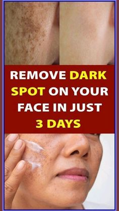 Clear Skin Fast, Get Rid Of Wrinkles, Skin Care Treatments, Dark Spots, Clear Skin, Natural Skin, Natural Skin Care, Natural Remedies