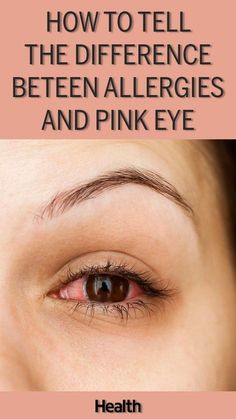 Eye Irritation Remedies, Itchy Eyes Remedy, Goopy Eyes, Treating Pink Eye, Eye Allergy Relief, Allergy Eyes, Natural Remedies For Migraines