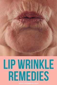 Wrinkles Around Lips, Makeup For Wrinkled Skin, Lip Wrinkles How To Get Rid Of, Wrinkly Lips, Frown Wrinkles, Eye Wrinkles Remedies, Wrinkles Around Mouth, Best Wrinkle Filler, Upper Lip Wrinkles